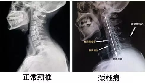 颈椎病怎么用理疗瑜伽改善？